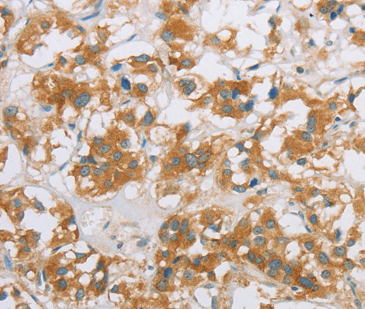 Immunohistochemistry of paraffin-embedded Human thyroid cancer using CYP2E1 Polyclonal Antibody at dilution of 1:35