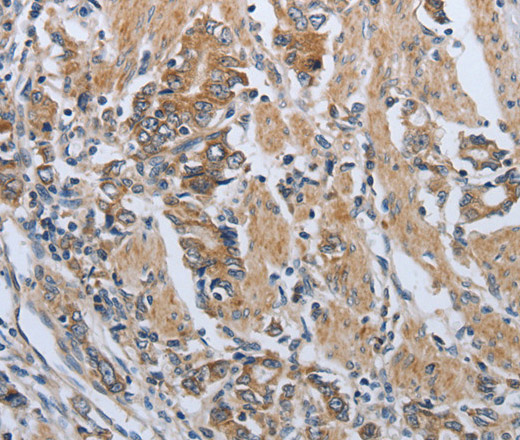 Immunohistochemistry of paraffin-embedded Human gasrtic cancer tissue using PD-1/CD279 Polyclonal Antibody at dilution 1:50