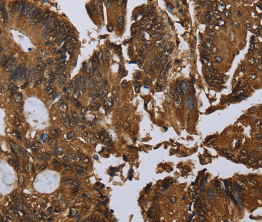 Immunohistochemistry of paraffin-embedded Human colon cancer tissue using MYBBP1A Polyclonal Antibody at dilution 1:40