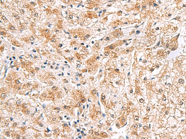 Immunohistochemistry of paraffin-embedded Human liver cancer tissue  using PDCL2 Polyclonal Antibody at dilution of 1:65(?200)