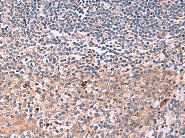 Immunohistochemistry of paraffin-embedded Human tonsil tissue  using IFNA1:IFNA13 Polyclonal Antibody at dilution of 1:35(?200)