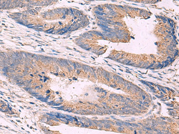 Immunohistochemistry of paraffin-embedded Human colorectal cancer tissue  using KCNN3 Polyclonal Antibody at dilution of 1:40(?200)