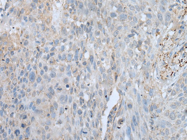 Immunohistochemistry of paraffin-embedded Human lung cancer tissue  using VWA2 Polyclonal Antibody at dilution of 1:45(?200)