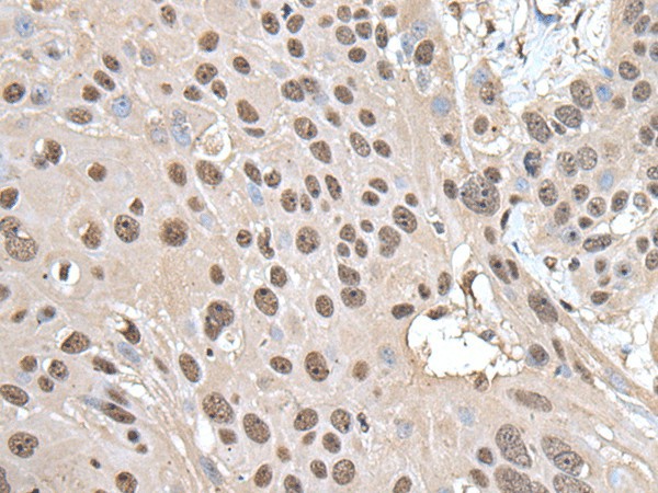 Immunohistochemistry of paraffin-embedded Human esophagus cancer tissue  using SMC1A Polyclonal Antibody at dilution of 1:30(?200)