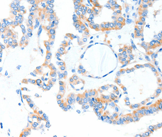 Immunohistochemistry of paraffin-embedded Human thyroid cancer tissue using TLR2 Polyclonal Antibody at dilution 1:55