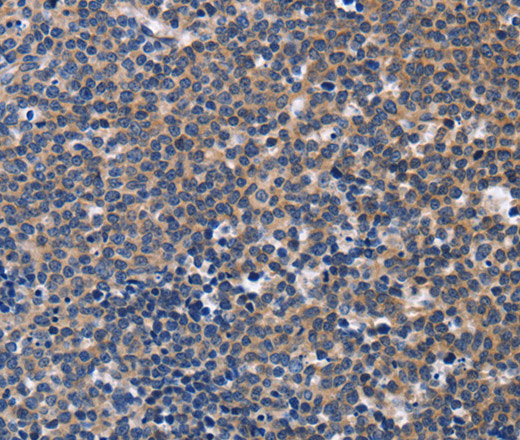 Immunohistochemistry of paraffin-embedded Human Lymphoma tissue using CCR6 Polyclonal Antibody at dilution 1:50