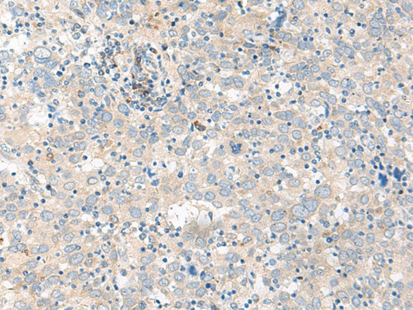 Immunohistochemistry of paraffin-embedded Human cervical cancer tissue  using GUCA1B Polyclonal Antibody at dilution of 1:45(?200)