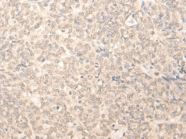 Immunohistochemistry of paraffin-embedded Human ovarian cancer tissue  using RUVBL2 Polyclonal Antibody at dilution of 1:25(?200)