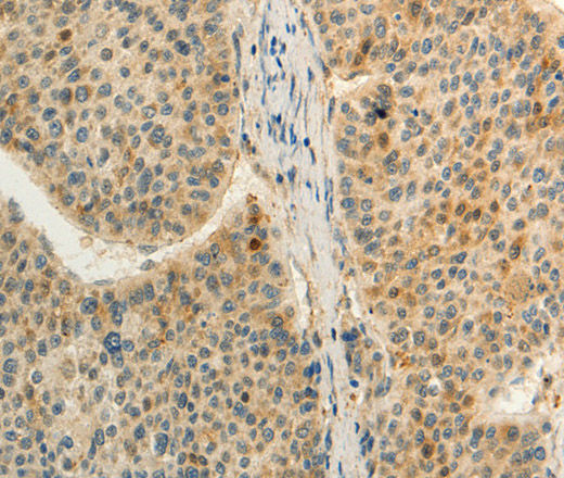 Immunohistochemistry of paraffin-embedded Human liver cancer tissue using FZD8 Polyclonal Antibody at dilution 1:50