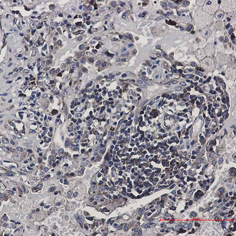 Immunohistochemistry of eIF4B in paraffin-embedded Human lung cancer tissue using eIF4B Rabbit mAb at dilution 1:50