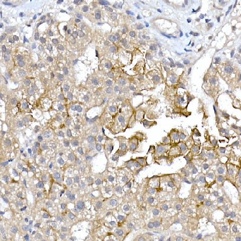 Immunohistochemistry of paraffin-embedded human liver cancer using AQP9 Polyclonal Antibody at dilution of 1:150 (40x lens).Perform high pressure antigen retrieval with 10 mM citrate buffer pH 6.0 before commencing with IHC staining protocol.