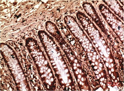 Immunohistochemistry of paraffin-embedded Human colon carcinoma tissue using gamma Tubulin Monoclonal Antibody at dilution of 1:200.