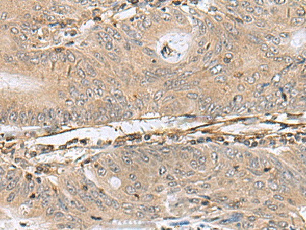 Immunohistochemistry of paraffin-embedded Human colorectal cancer tissue  using PTPRS Polyclonal Antibody at dilution of 1:110(?200)