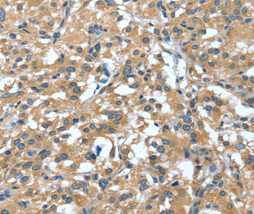 Immunohistochemistry of paraffin-embedded Human thyroid cancer tissue using DTX1 Polyclonal Antibody at dilution 1:30