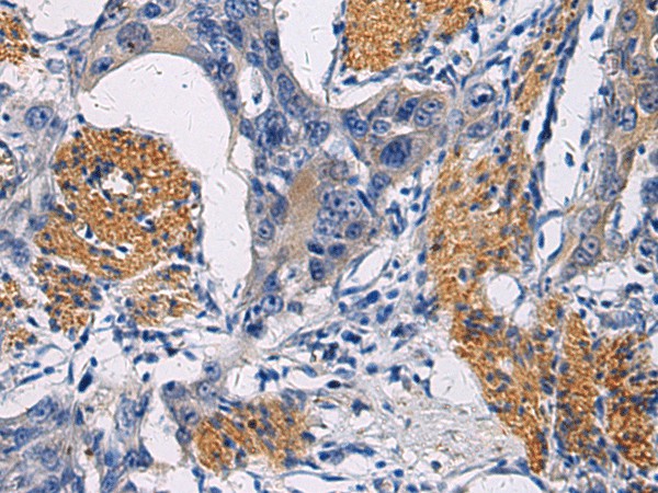 Immunohistochemistry of paraffin-embedded Human esophagus cancer tissue  using FAM20C Polyclonal Antibody at dilution of 1:45(?200)