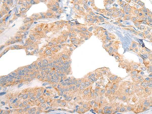 Immunohistochemistry of paraffin-embedded Human thyroid cancer tissue  using RGS19 Polyclonal Antibody at dilution of 1:40(?200)