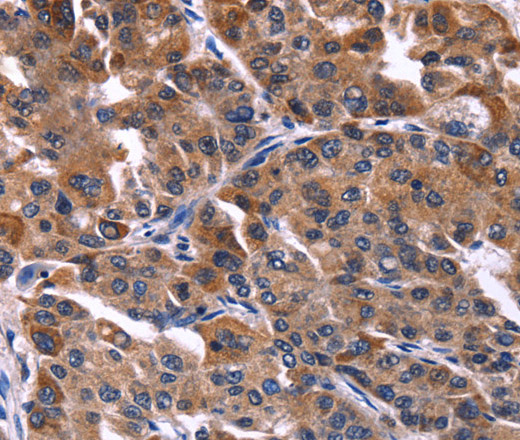 Immunohistochemistry of paraffin-embedded Human liver cancer tissue using NFATC3 Polyclonal Antibody at dilution 1:50