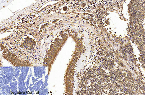 Immunohistochemistry of paraffin-embedded Human lung cancer tissue using Cleaved-PARP1 (D214) Polyclonal Antibody at dilution of 1:200.