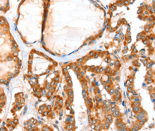 Immunohistochemistry of paraffin-embedded Human thyroid cancer tissue using ACOX1 Polyclonal Antibody at dilution 1:40