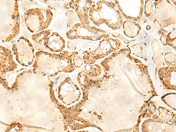 Immunohistochemistry of paraffin-embedded Human thyroid cancer tissue  using JPT1 Polyclonal Antibody at dilution of 1:35(?200)