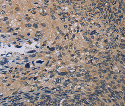 Immunohistochemistry of paraffin-embedded Human cervical cancer tissue using NOX1 Polyclonal Antibody at dilution 1:50