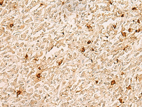 Immunohistochemistry of paraffin-embedded Human gastric cancer tissue  using TBCK Polyclonal Antibody at dilution of 1:25(?200)