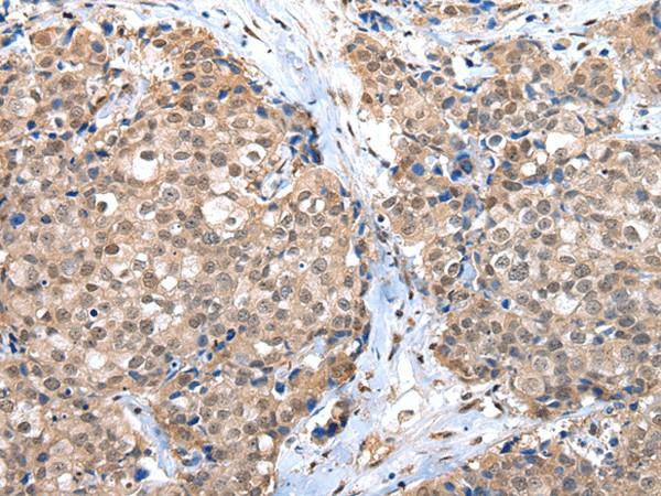 Immunohistochemistry of paraffin-embedded Human breast cancer tissue using CTBP1 Polyclonal Antibody at dilution 1:65