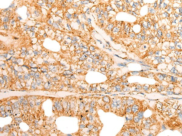 Immunohistochemistry of paraffin-embedded Human gastric cancer tissue  using CHCHD3 Polyclonal Antibody at dilution of 1:45(?200)