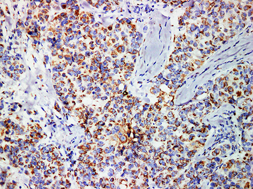 Immunohistochemistry of paraffinembedded Human breast cancer tissue with Mammaglobin Monoclonal Antibody(Antigen repaired by EDTA).