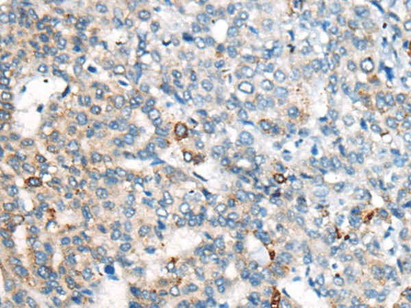 Immunohistochemistry of paraffin-embedded Human liver cancer tissue  using CES2 Polyclonal Antibody at dilution of 1:55(?200)