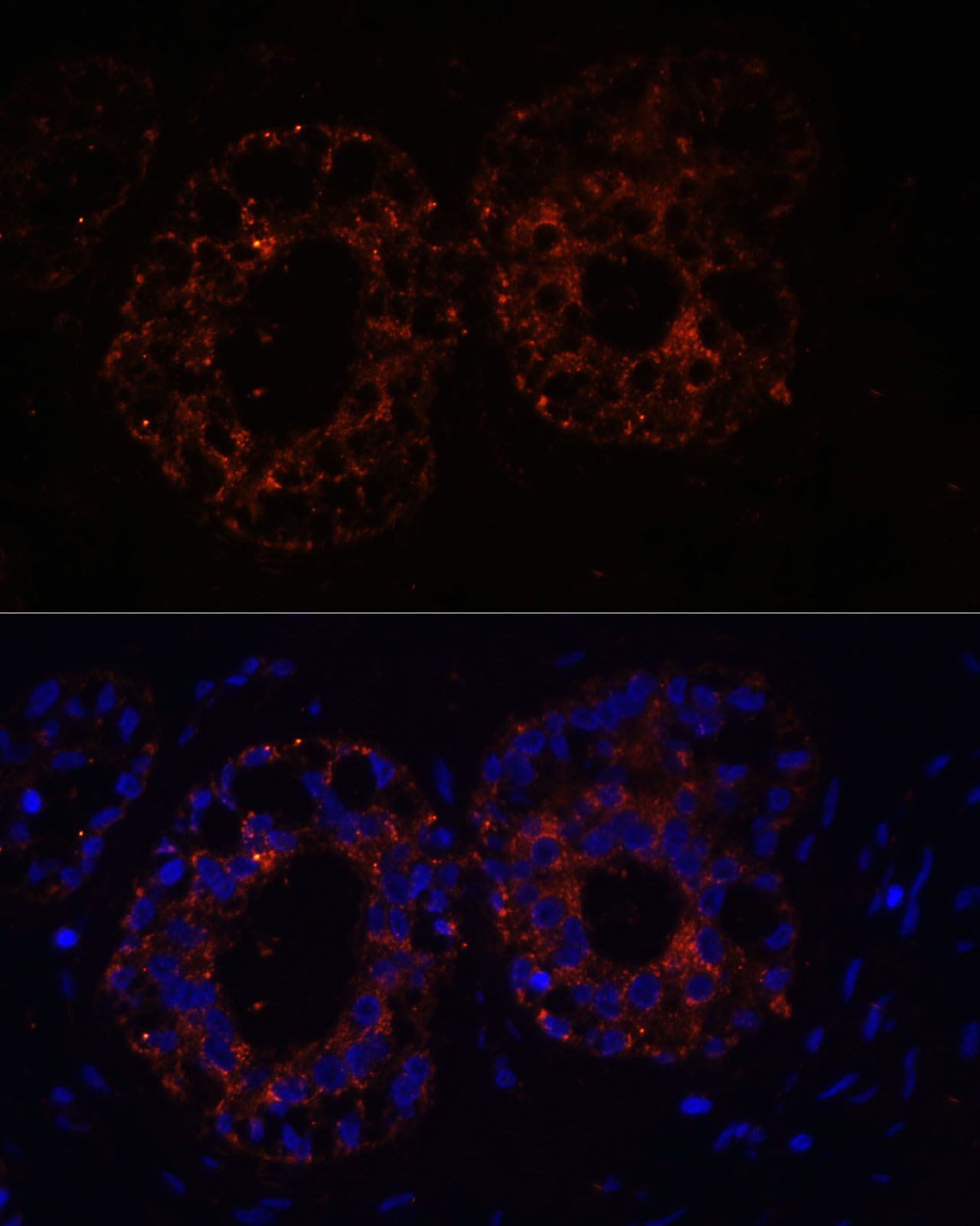 Immunofluorescence analysis of Human mammary cancer cells using TNF-α Polyclonal antibody at dilution of 1:100. Blue:DAPI for nuclear staining.