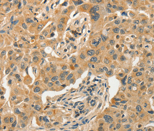 Immunohistochemistry of paraffin-embedded Human lung cancer tissue using SLC11A2 Polyclonal Antibody at dilution 1:50