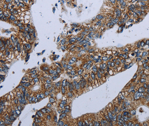 Immunohistochemistry of paraffin-embedded Human colon cancer using NDUFA13 Polyclonal Antibody at dilution of 1:40