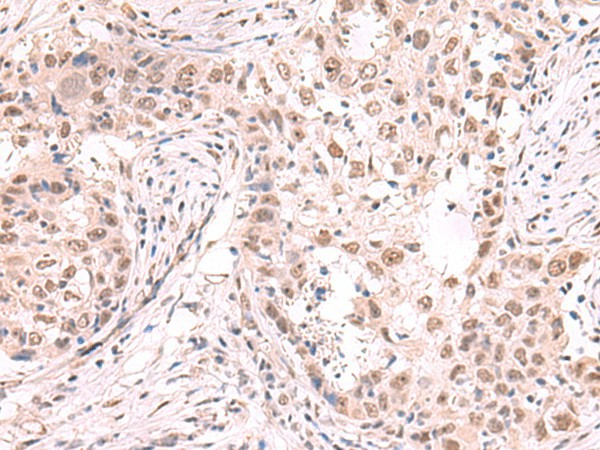 Immunohistochemistry of paraffin-embedded Human esophagus cancer tissue  using ZNF559 Polyclonal Antibody at dilution of 1:80(?200)