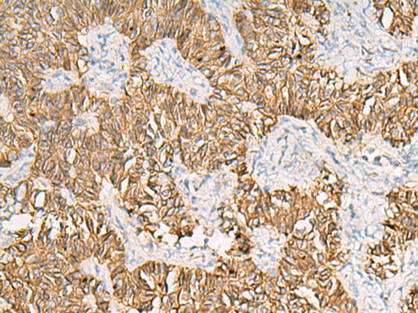 Immunohistochemistry of paraffin-embedded Human ovarian cancer tissue  using SLC16A1 Polyclonal Antibody at dilution of 1:30(?200)