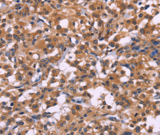 Immunohistochemistry of paraffin-embedded Human thyroid cancer tissue using SELPLG Polyclonal Antibody at dilution 1:50