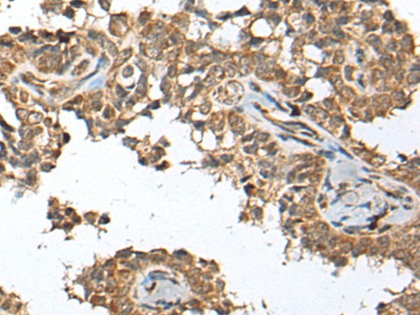 Immunohistochemistry of paraffin-embedded Human ovarian cancer tissue  using SPRTN Polyclonal Antibody at dilution of 1:65(?200)