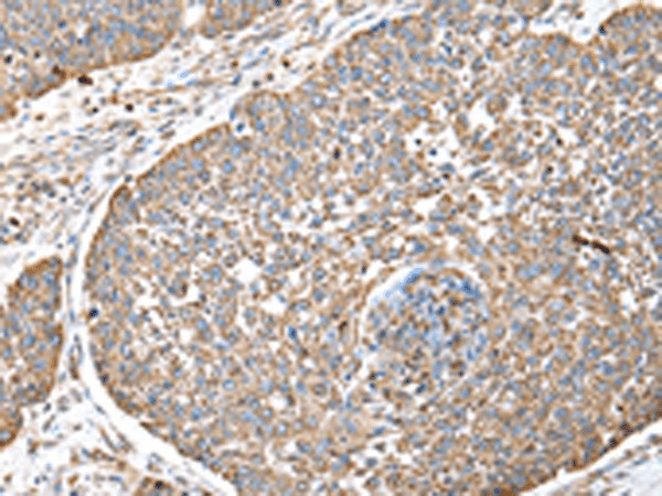 Immunohistochemistry of paraffin-embedded Human lung cancer tissue  using DPH7 Polyclonal Antibody at dilution of 1:40(?200)