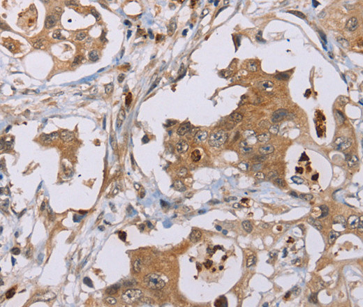 Immunohistochemistry of paraffin-embedded Human colon cancer using OTC Polyclonal Antibody at dilution of 1:40