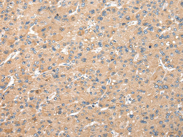 Immunohistochemistry of paraffin-embedded Human liver cancer tissue  using WDR18 Polyclonal Antibody at dilution of 1:25(?200)