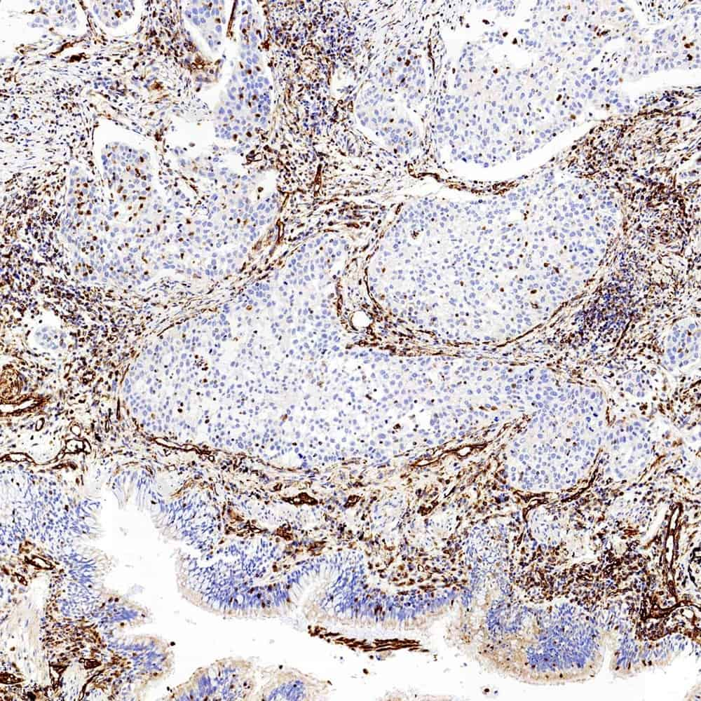 Immunohistochemistry analysis of paraffin-embedded Human lung cancer  using Vimentin Polyclonal Antibody at dilution of 1:300.