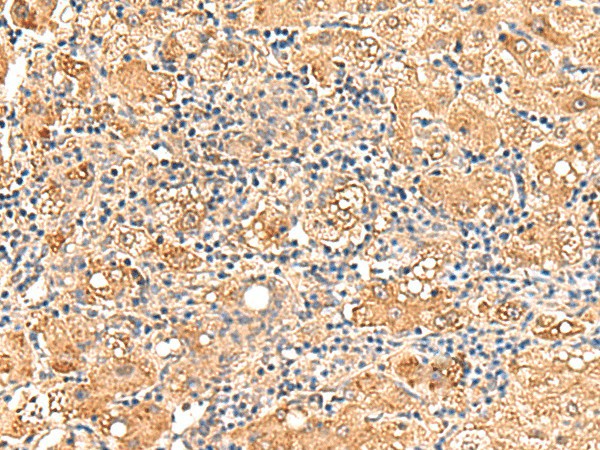 Immunohistochemistry of paraffin-embedded Human liver cancer tissue  using GPD1L Polyclonal Antibody at dilution of 1:60(?200)