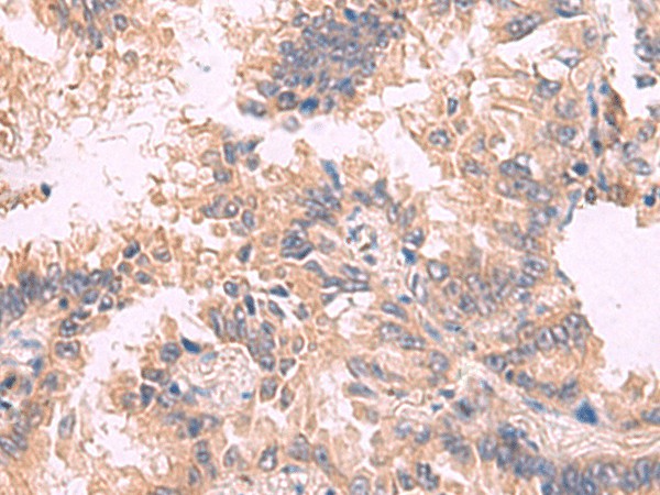 Immunohistochemistry of paraffin-embedded Human lung cancer tissue  using TJP1 Polyclonal Antibody at dilution of 1:30(?200)