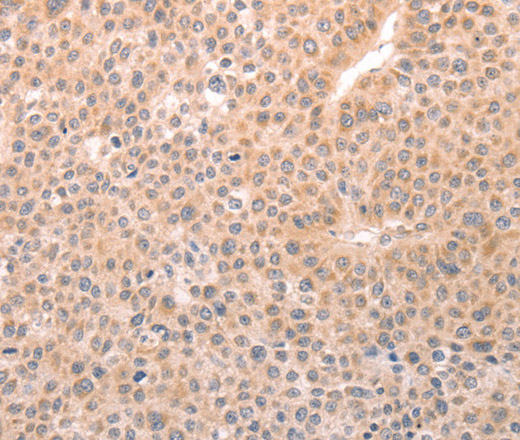 Immunohistochemistry of paraffin-embedded Human liver cancer tissue using TRPC3 Polyclonal Antibody at dilution 1:50