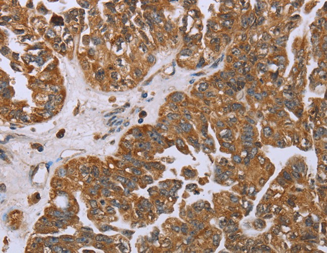 Immunohistochemistry of paraffin-embedded Human ovarian cancer using NOV Polyclonal Antibody at dilution of 1:25