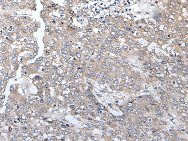 Immunohistochemistry of paraffin-embedded Human liver cancer tissue  using BRMS1L Polyclonal Antibody at dilution of 1:45(?200)