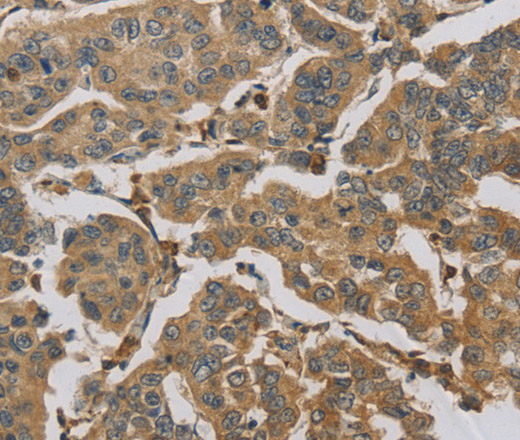 Immunohistochemistry of paraffin-embedded Human breast cancer tissue using TBXAS1 Polyclonal Antibody at dilution 1:30