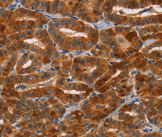 Immunohistochemistry of paraffin-embedded Human thyroid cancer tissue using NCR1 Polyclonal Antibody at dilution 1:30