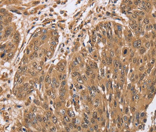 Immunohistochemistry of paraffin-embedded Human lung cancer tissue using PTPN20 Polyclonal Antibody at dilution 1:40