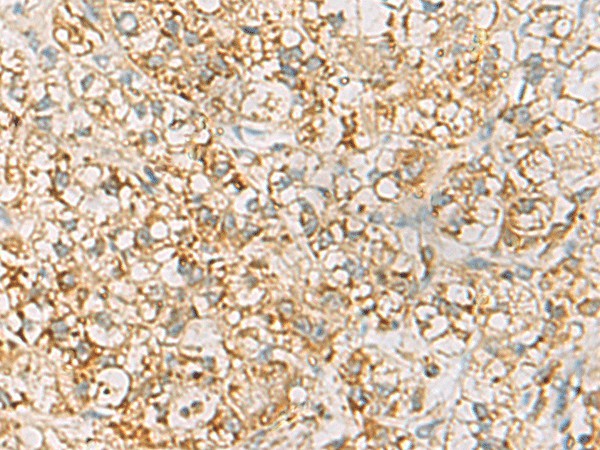 Immunohistochemistry of paraffin-embedded Human liver cancer tissue  using HLA-DQB2 Polyclonal Antibody at dilution of 1:70(?200)